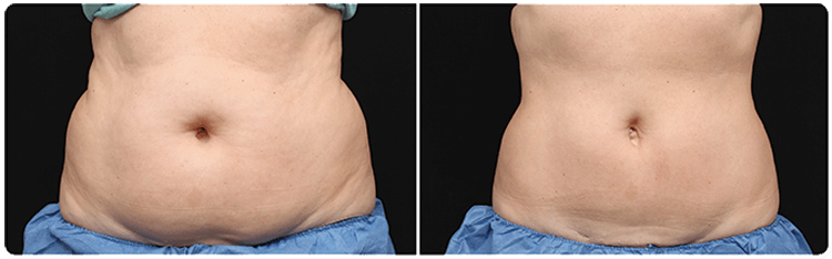CoolSculpting Before & After | Radiant Reflections