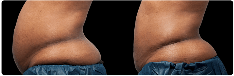 CoolSculpting Before & After | Radiant Reflections