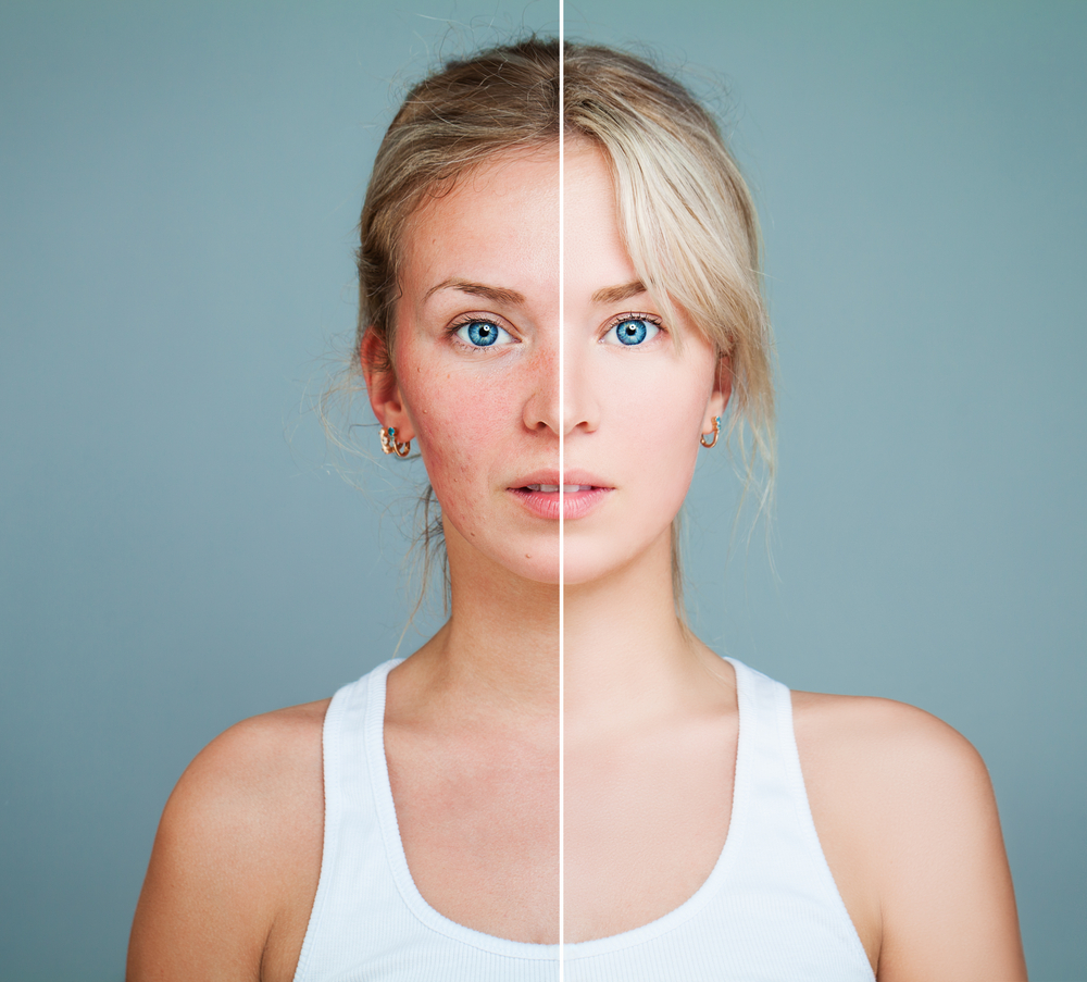 How Much Does Laser Acne Treatment Cost? - Radiant Reflections