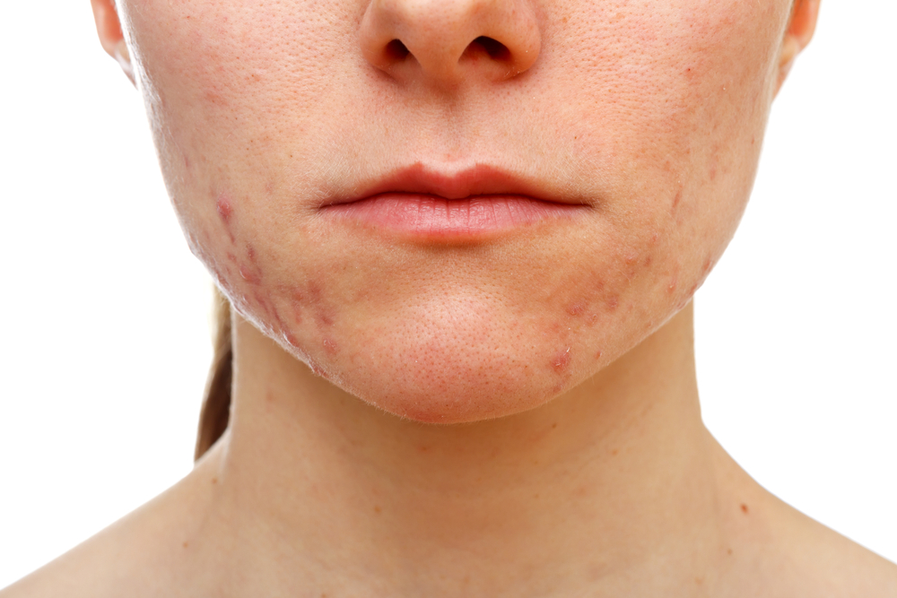 Is Laser Treatment Good for Acne 637710066794451988