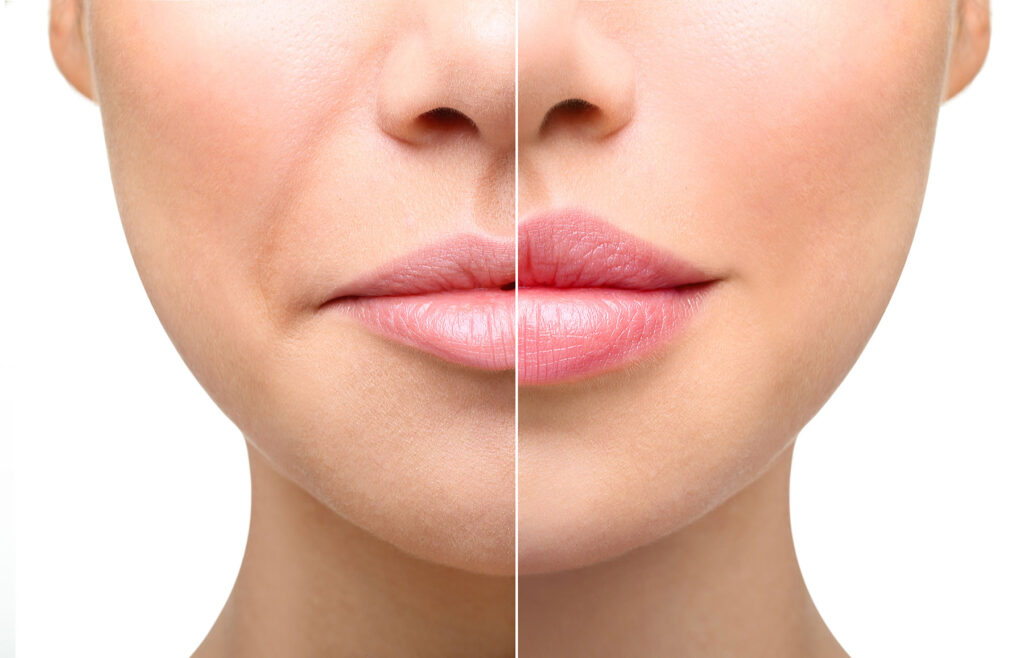 Fillers &#038; Injectables