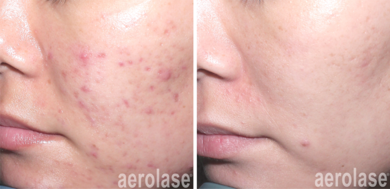 aerolase-acne-spade-before-after-watermark-6-treatments