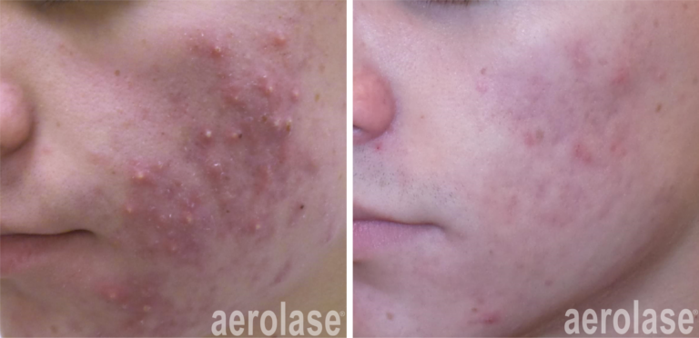 aerolase-kevin-pinski-before-after-acne-4-treatments