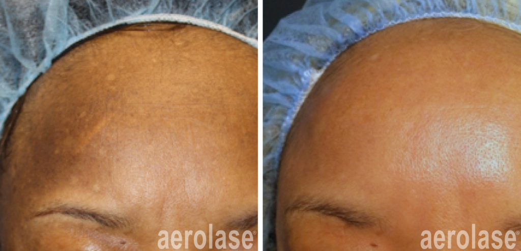 aerolase-melasma-before-after-cheryl-burgess-1-treatment