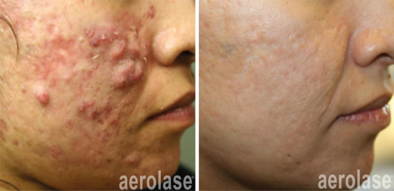 aerolase michael gold acne treatments